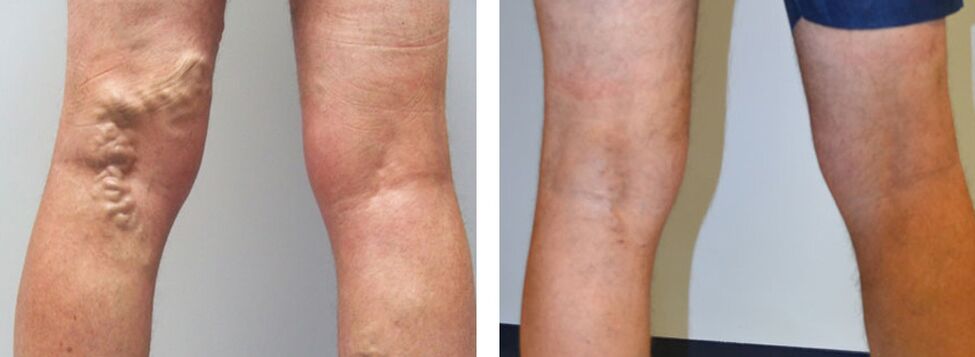 Veniselle kullanmadan önce ve sonra fotoğraf, krem ​​kullanma deneyimi