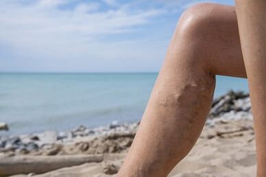 Bacaklarda varisli damarlar