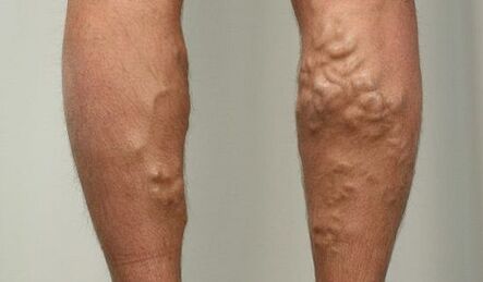 Varisli damar belirtileri