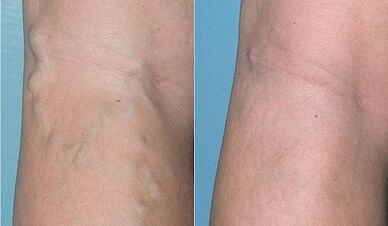 Bacaklarda varisli damarlar nasıl tedavi edilir