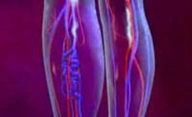 Varisli damarların nedenleri ve tedavisi