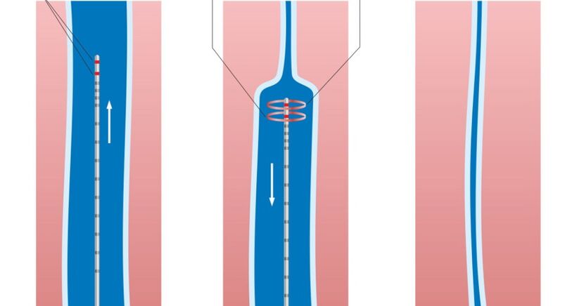 Bacaklardaki varisli damarlar için lazer tedavisi
