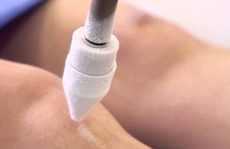 Bacaklardaki varisli damarların kriyoterapi ile tedavisi