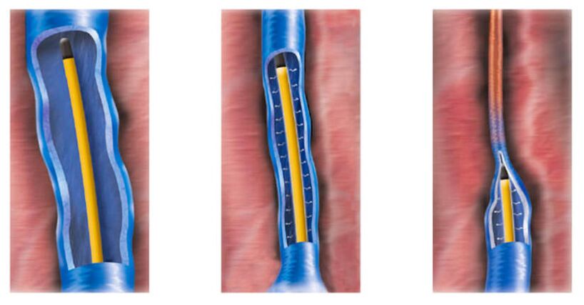 Varisli damarların tedavisinde bir yöntem olarak radyofrekans ablasyonu