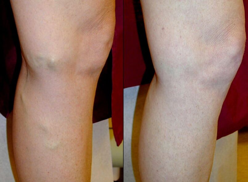 bacaklardaki varisli damarları tedavi etme yöntemleri